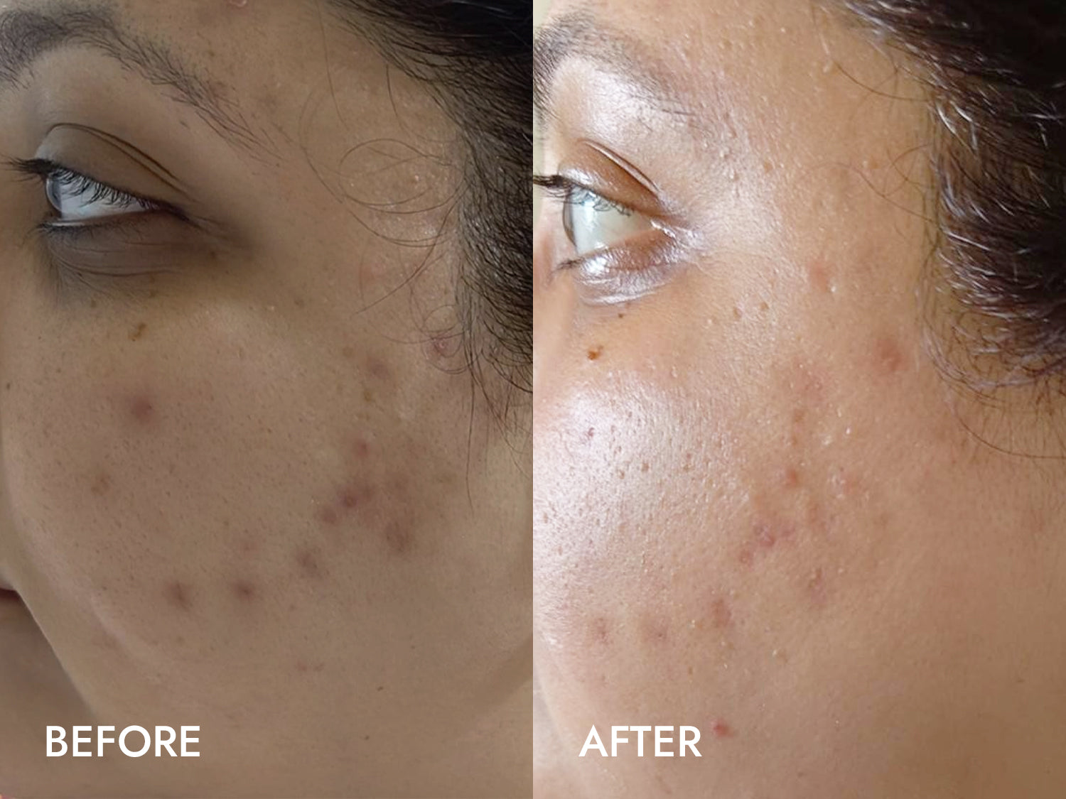 From Severe Breakouts to Fading Dark Spots: Shruti's 3-Week Journey with Haridra Quench