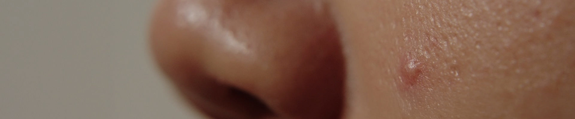 Acne Care Products (Non Toxic)