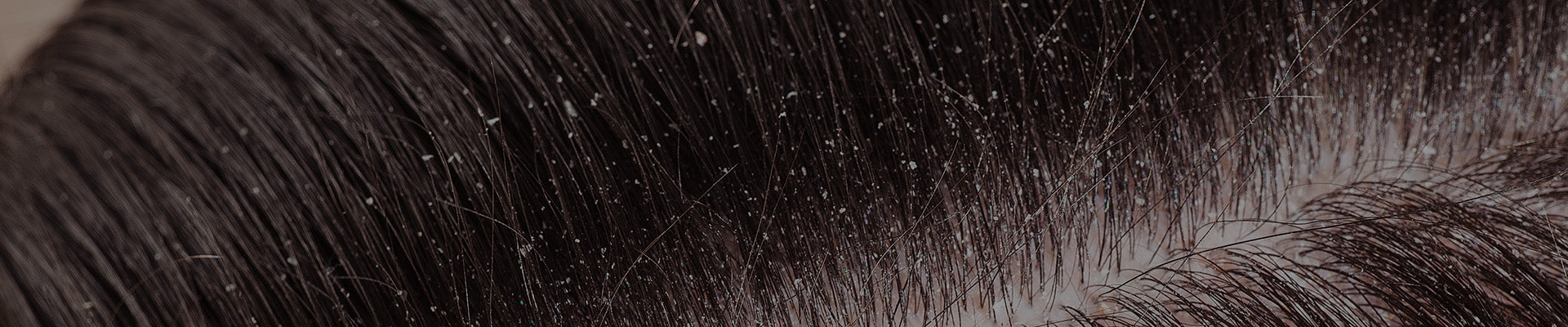 Hair Products For Dandruff (Sulphate Free)