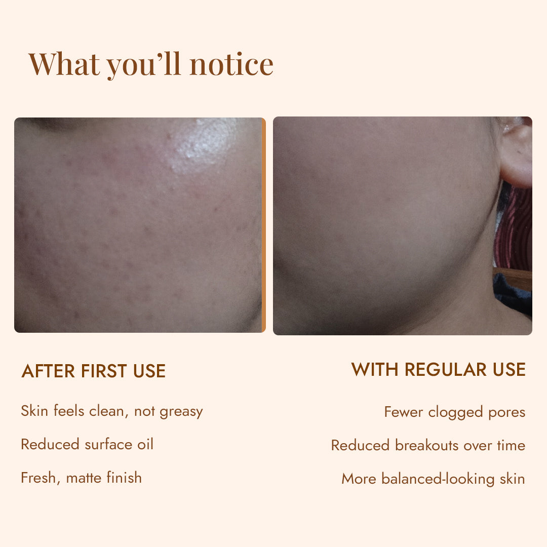 Skin before and after JiViSa Nimba Tulsi Ubtan help reduce surface oil and clogged pores for a fresh, matte finish
