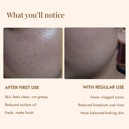 Skin before and after JiViSa Nimba Tulsi Ubtan help reduce surface oil and clogged pores for a fresh, matte finish