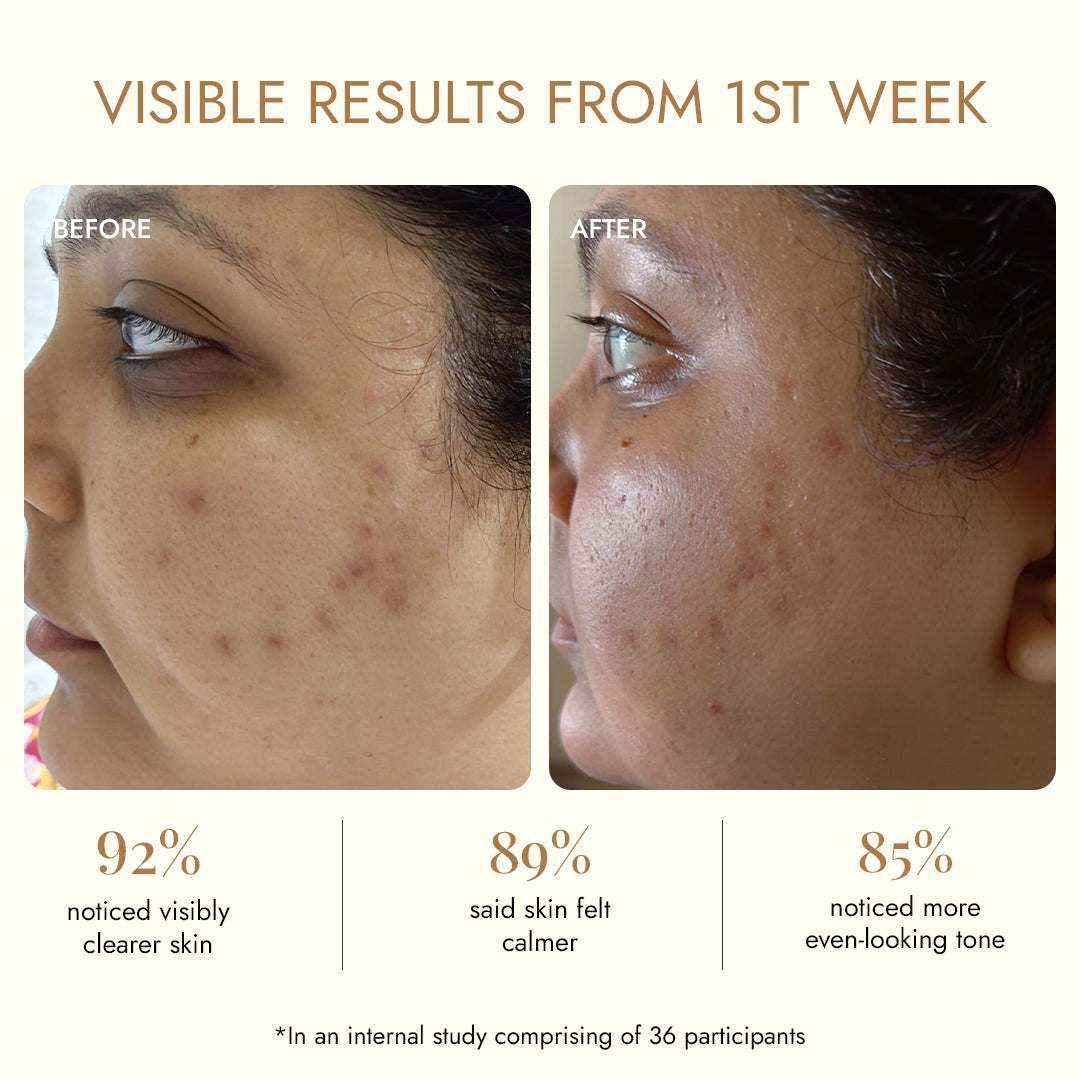 Before and after dark spots on face results in week 1 — 92% saw visibly clearer skin, Haridra Quench dark spot removal cream study